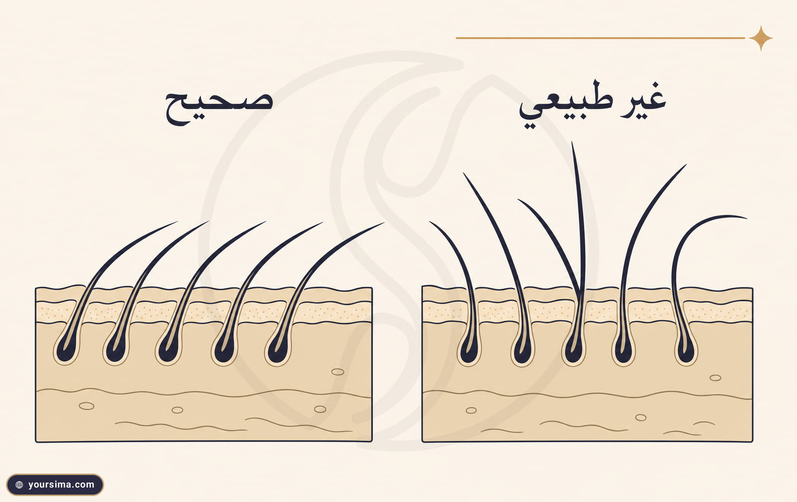 مخطط تعليمي يقارن زاوية نمو شعر الحاجب الطبيعية الصحيحة بالزاوية غير الطبيعية في الزراعة