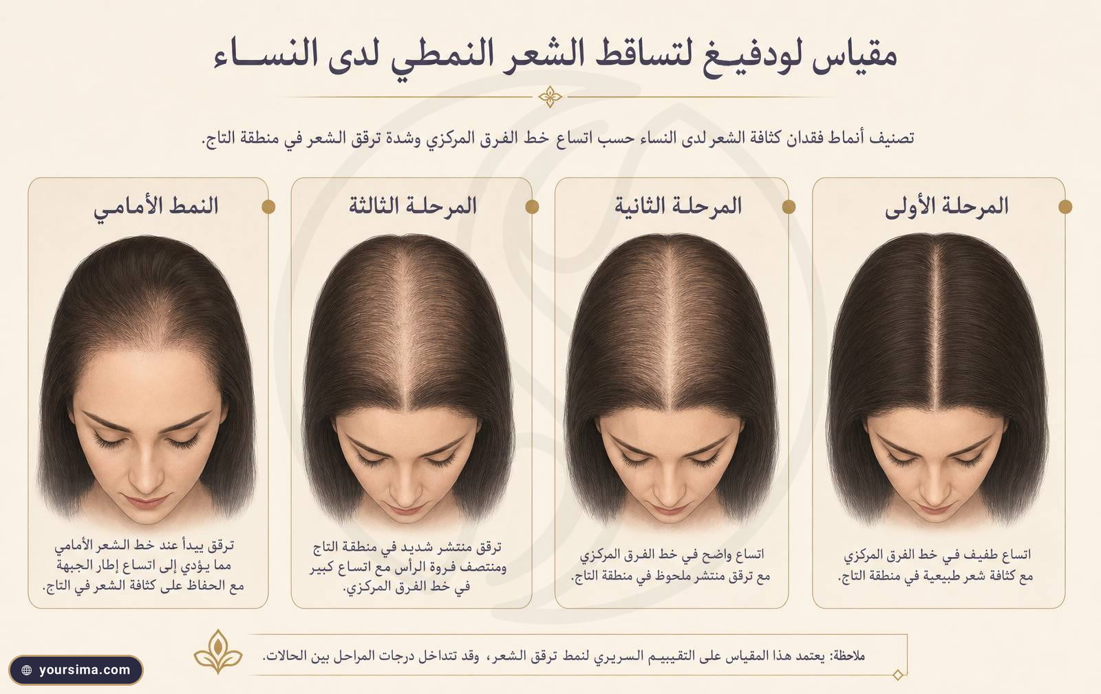 رسم توضيحيّ لمراحل مقياس Ludwig الثلاث عند المرأة يبيّن ترقّق التاج واتّساع خطّ الفرق مع بقاء خطّ الجبهة محفوظاً