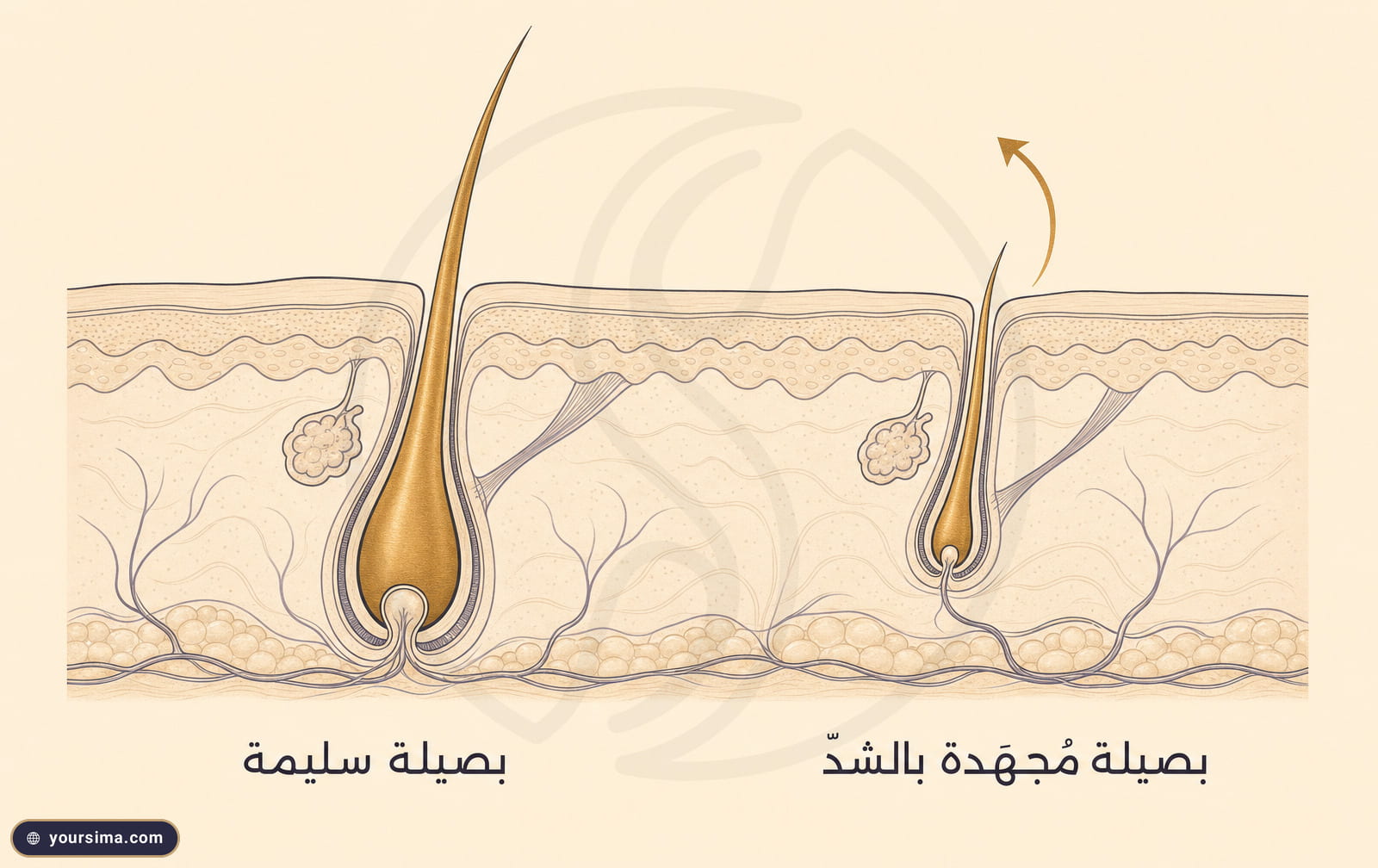 رسم يقارن بصيلةً سليمةً ببصيلة مجهدة بالشد تصغر وتنتج شعرةً أرق مع سهم يبين قوة الشد