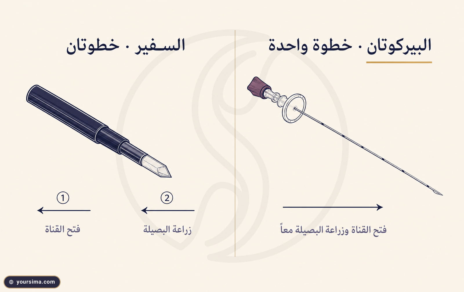 إنفوغرافيك يقارن إبرة البيركوتان بخطوة واحدة مقابل شفرة السفير بخطوتين، فتح القناة ثم زراعة البصيلة