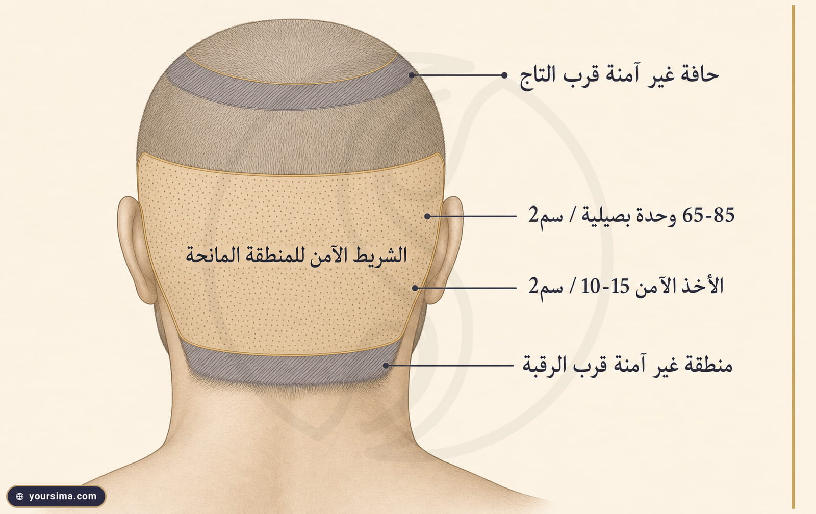 مخطّط تشريحي لمؤخّرة الرأس يوضّح الشريط الآمن في المنطقة المانحة مقابل حواف الإفراط قرب الرقبة والتاج