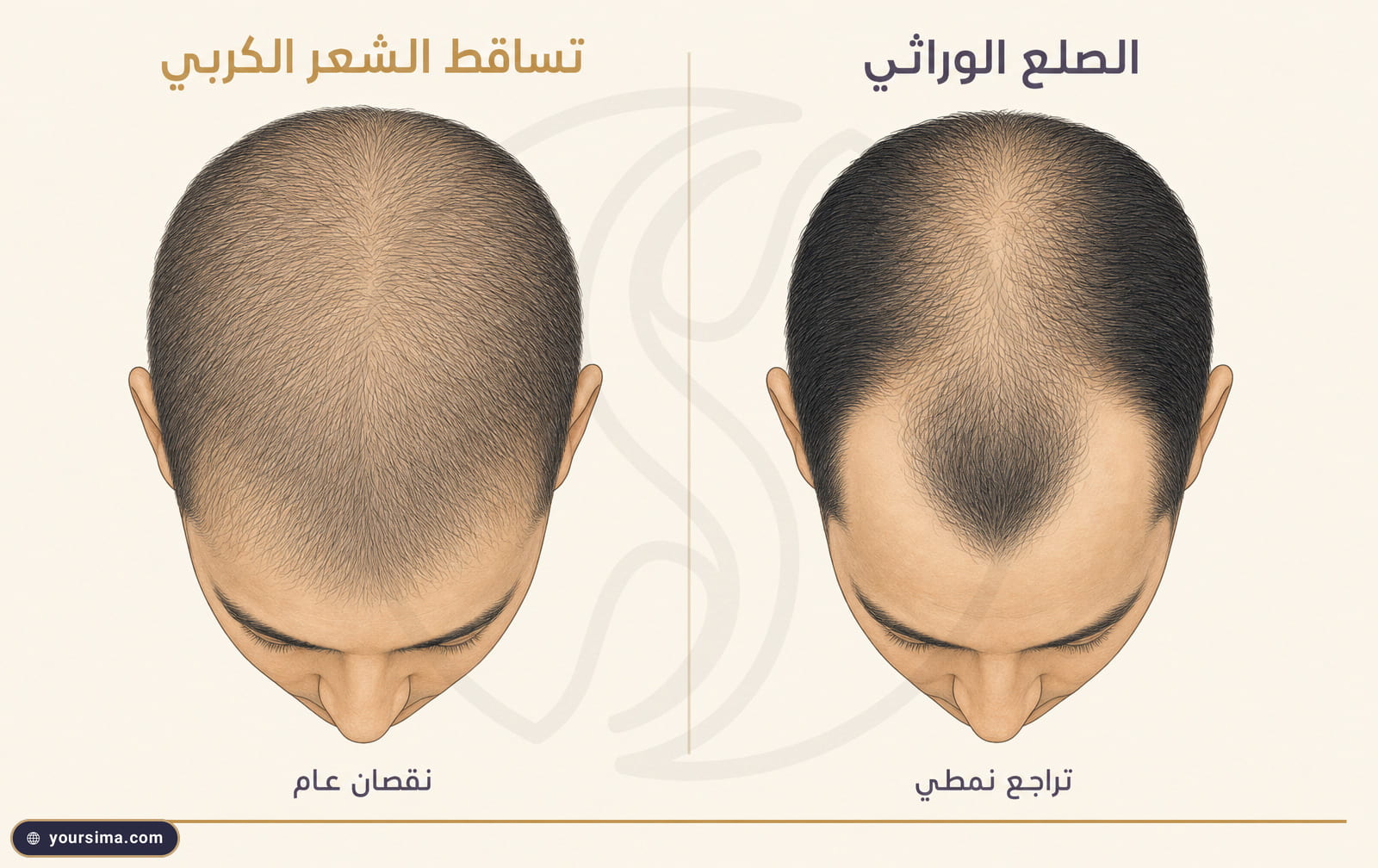 مخطط من لوحتين يقارن التساقط الكربي المنتشر على كامل الفروة بالصلع الوراثي ذي التراجع النمطي عند الجبهة والتاج